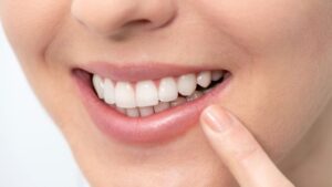 What is a Root Canal?